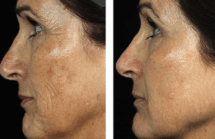 Före och efter fraktionerad ansiktsföryngring