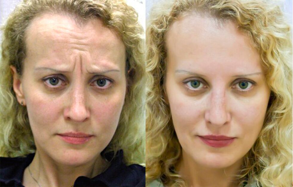 före och efter användning av massageapparaten för föryngring ltza foto 1
