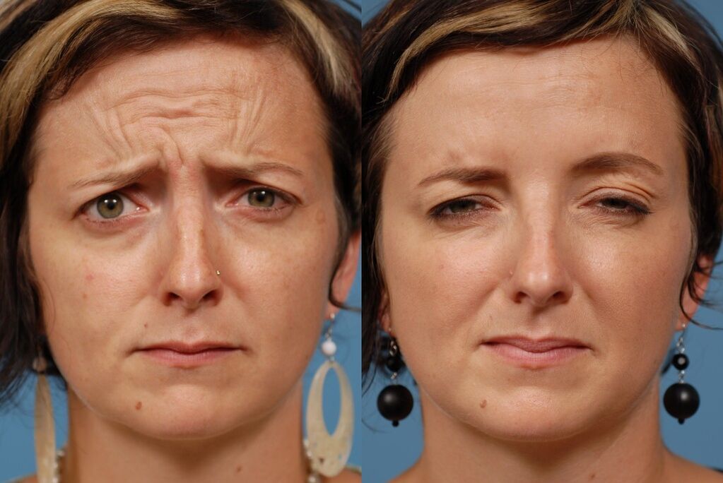 före och efter användning av massageapparaten för föryngring ltza foto 2