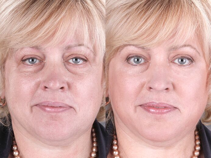 före och efter användning av massageapparaten för föryngring ltza foto 3