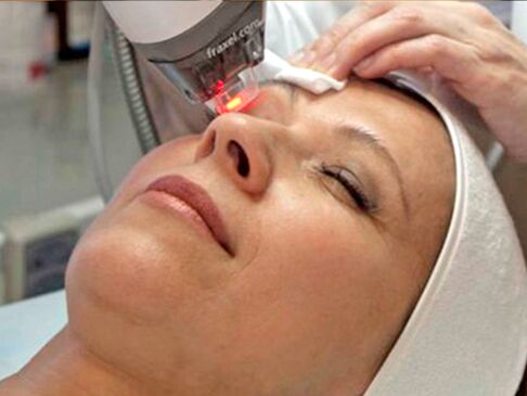 laserföryngring av huden runt ögonen