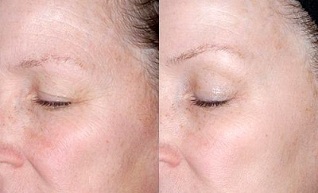 föryngring av huden runt ögonen före och efter foton