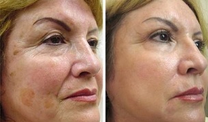 fraktionerad hudföryngring före och efter foton