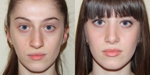 före och efter hudföryngring i plasma